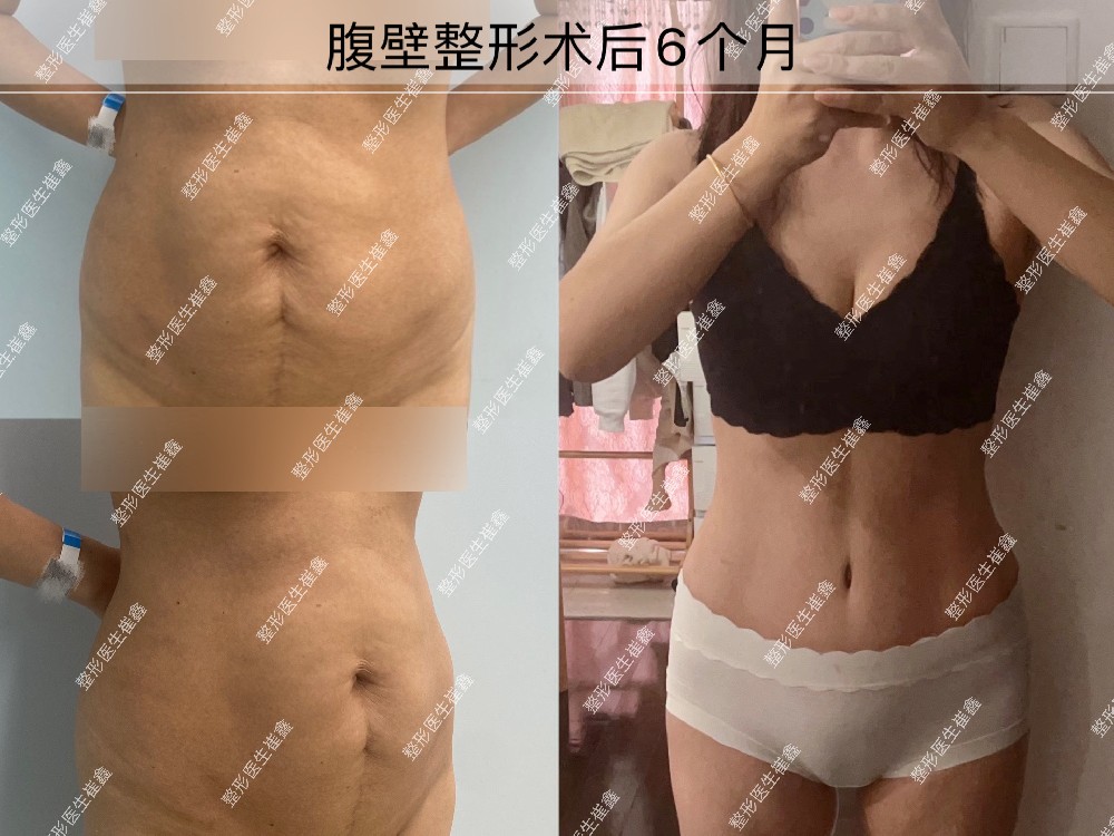 腹壁整形术后6个月