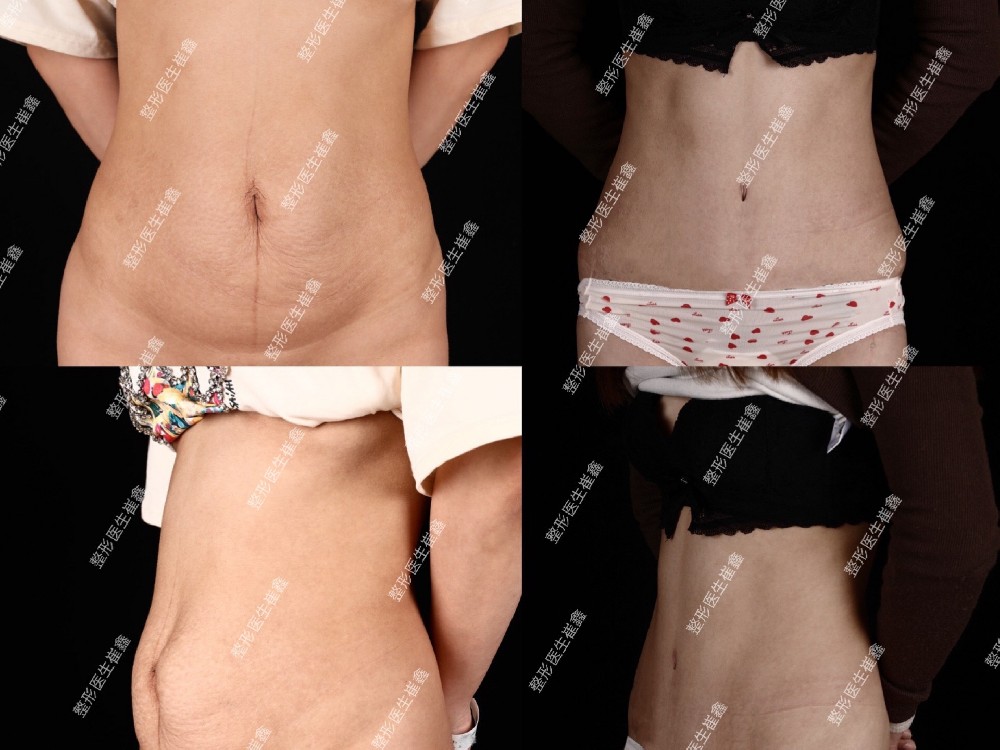 腹壁整形术后1年5个月