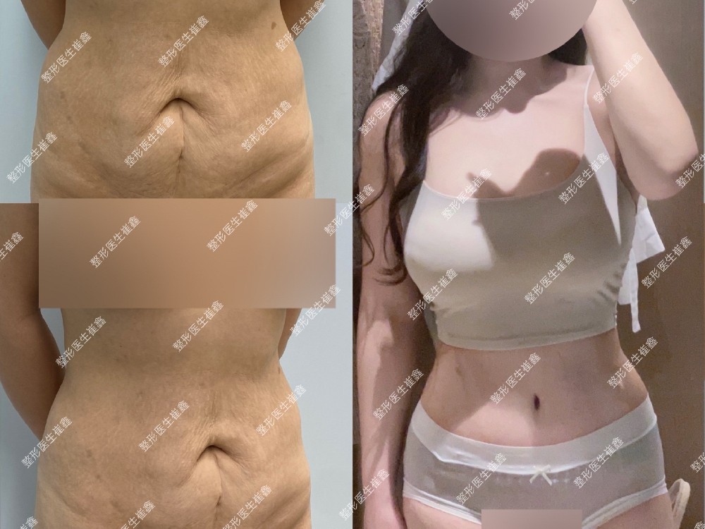 腹壁整形术后96天及瘢痕反馈