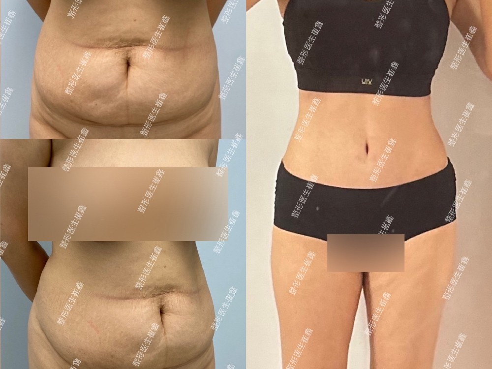 腹壁整形术后2个月