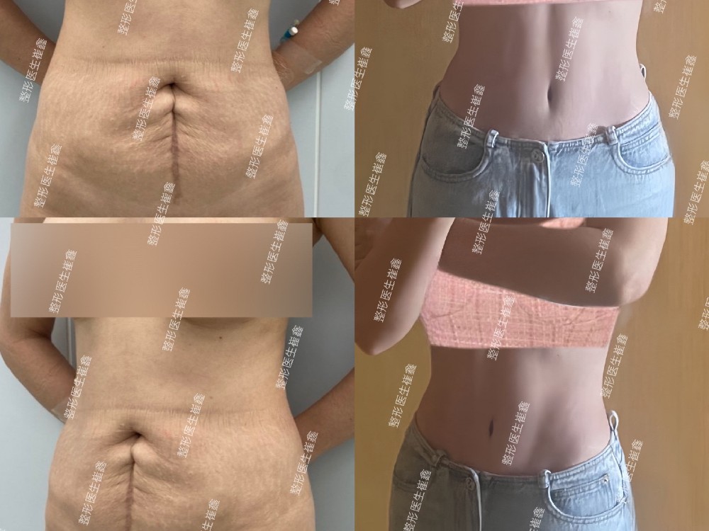 腹壁整形术后101天