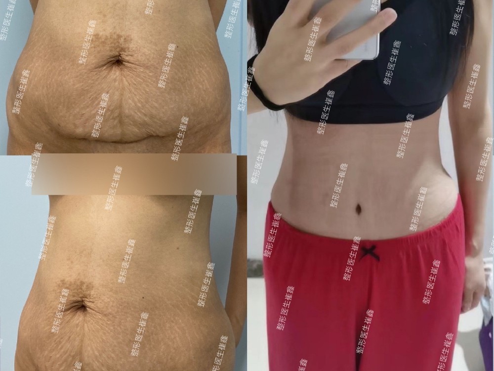 腹壁整形术后52天