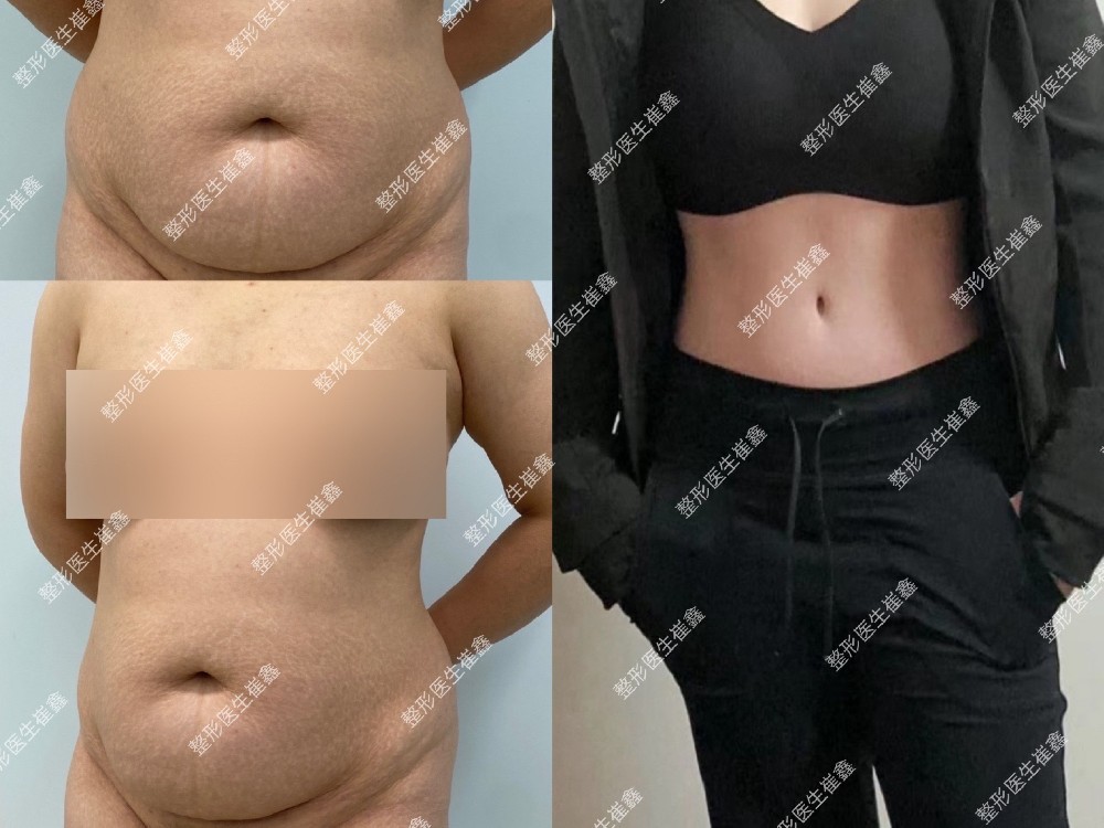 腹壁整形术后104天