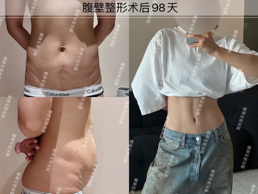 腹壁整形术后98天