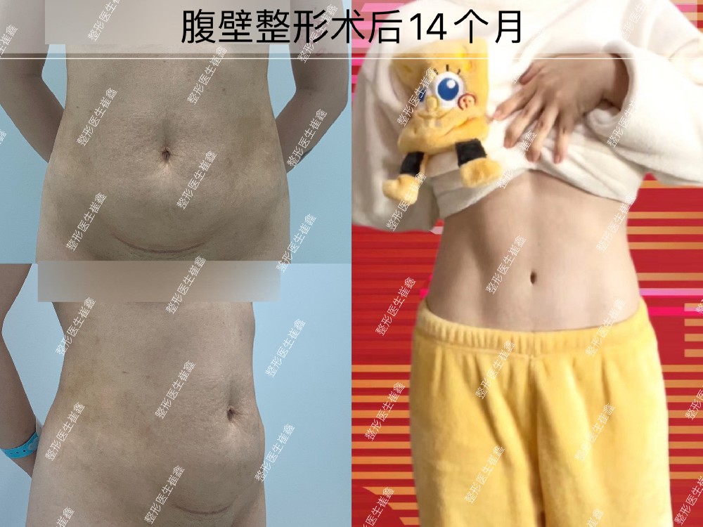 腹壁整形术后14个月