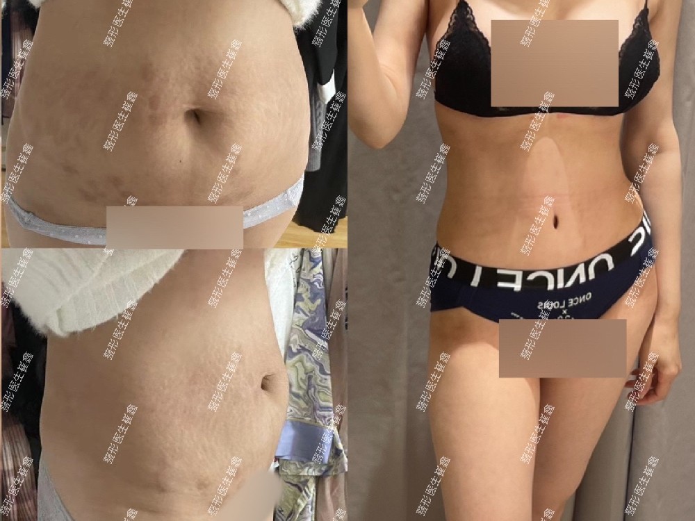 腹壁整形术后6个月