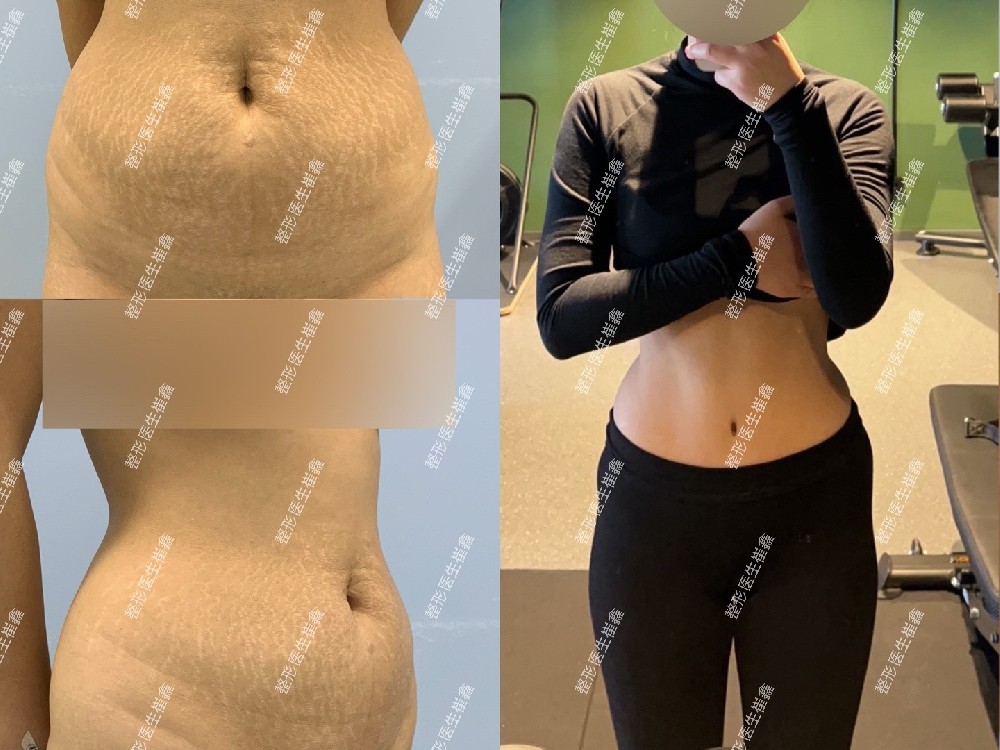 腹壁整形术后17个月