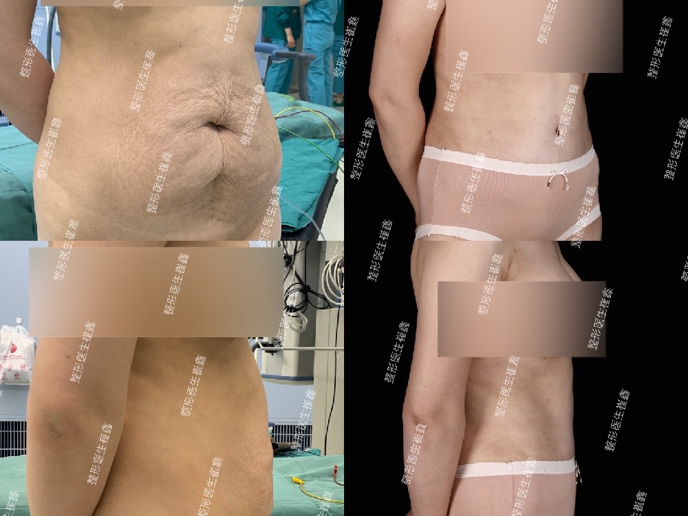 腹壁整形术后19个月
