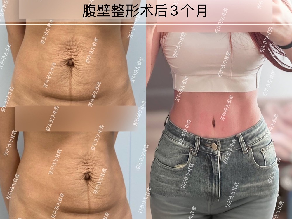 腹壁整形术后3个月