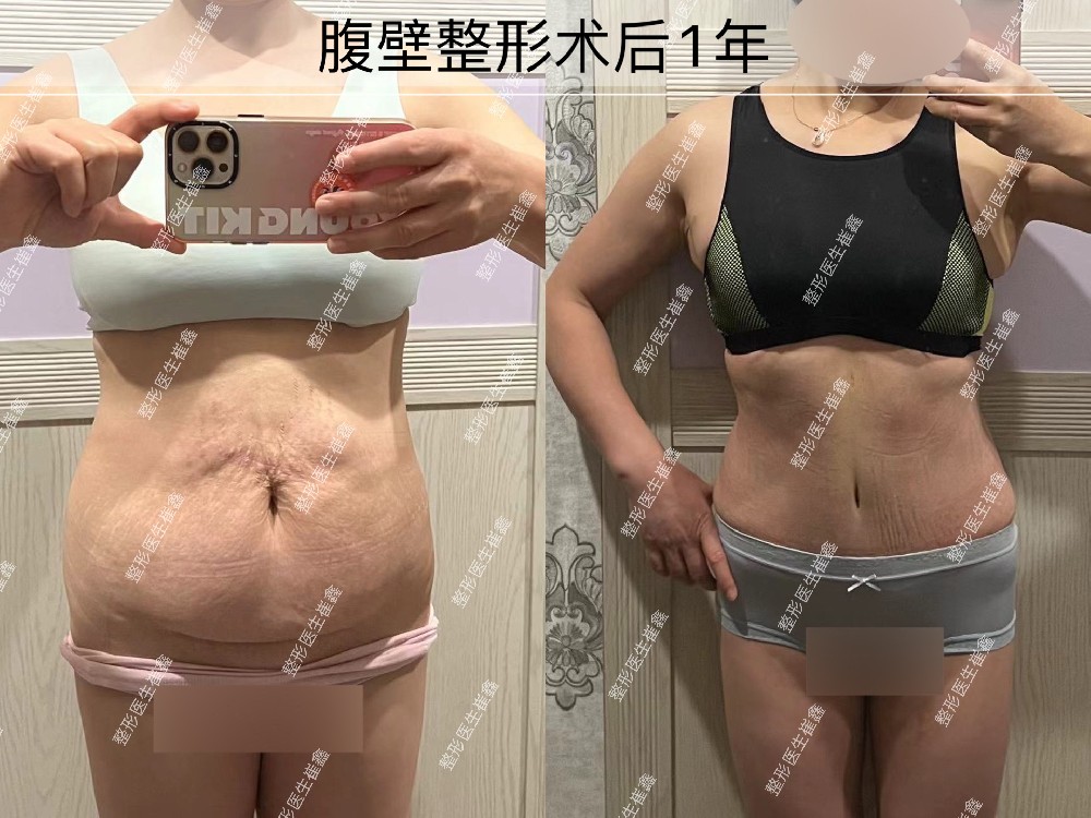 腹壁整形术后1年