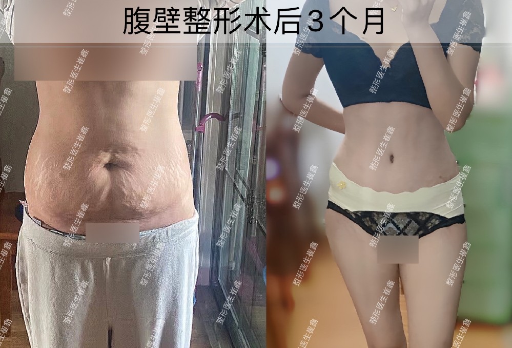 腹壁整形术后3个月