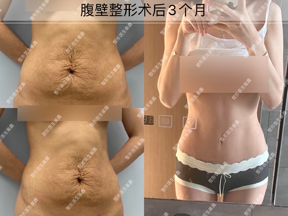 腹壁整形术后3个月