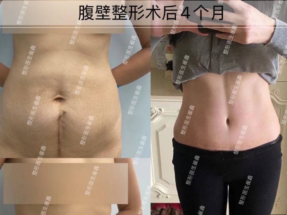 腹壁整形术后4个月