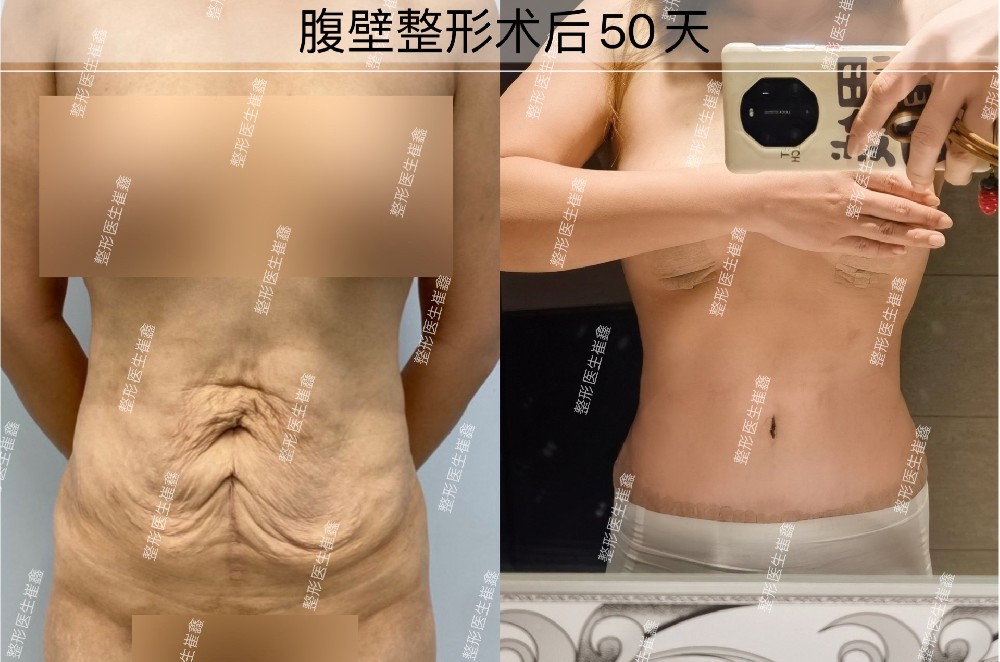 腹壁整形术后50天