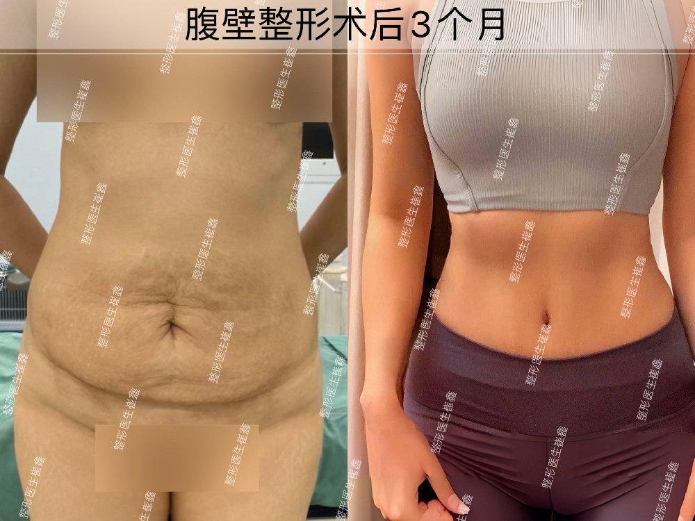 腹壁整形术后3个月