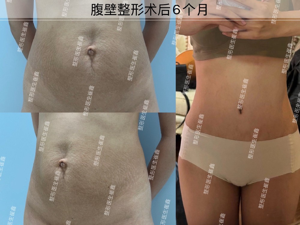 腹壁整形术后6个月