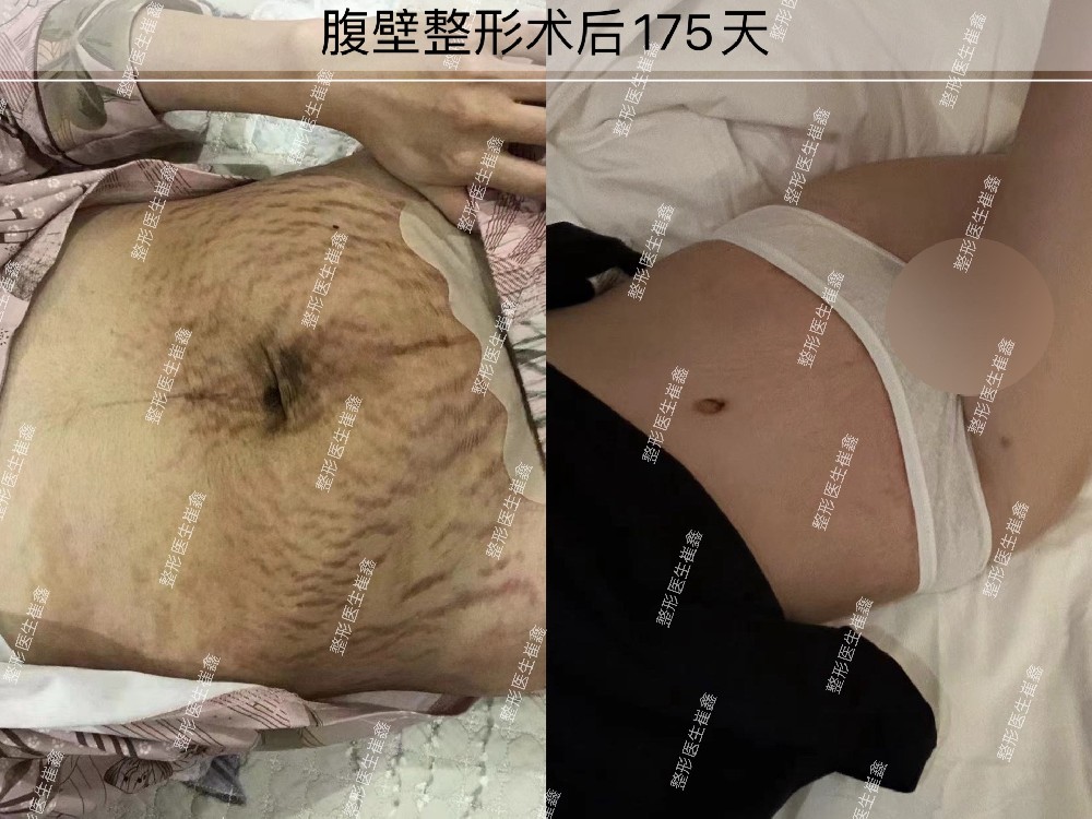 腹壁整形术后175天