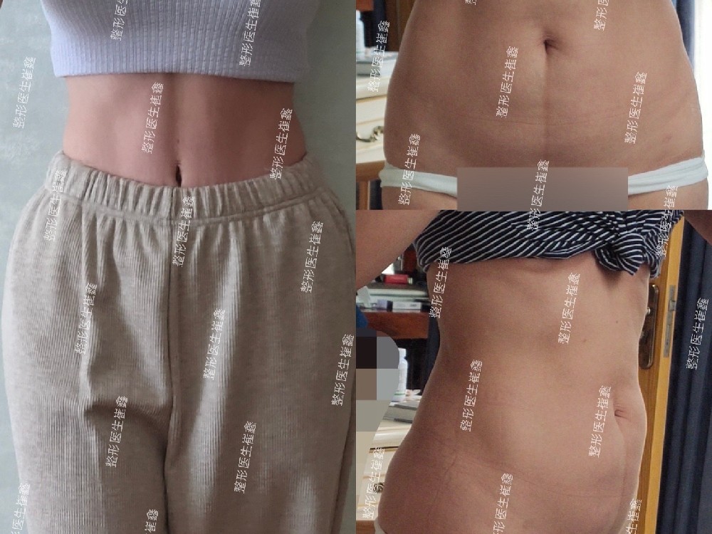 腹壁整形术后2个月