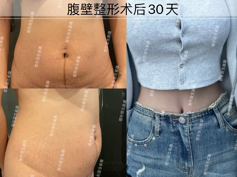 腹壁整形术后30天