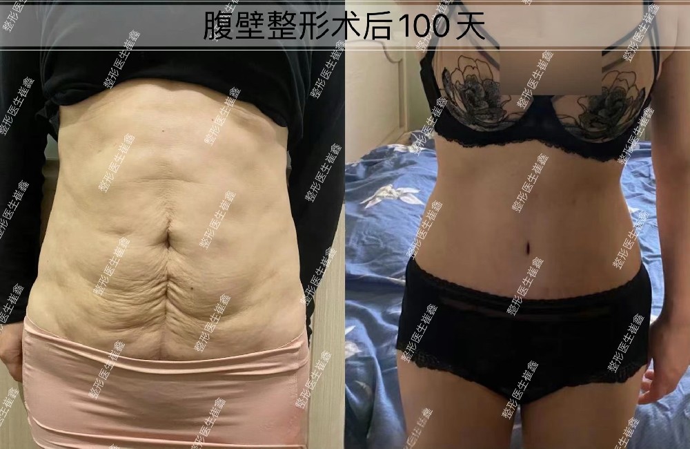 腹壁整形术后100天