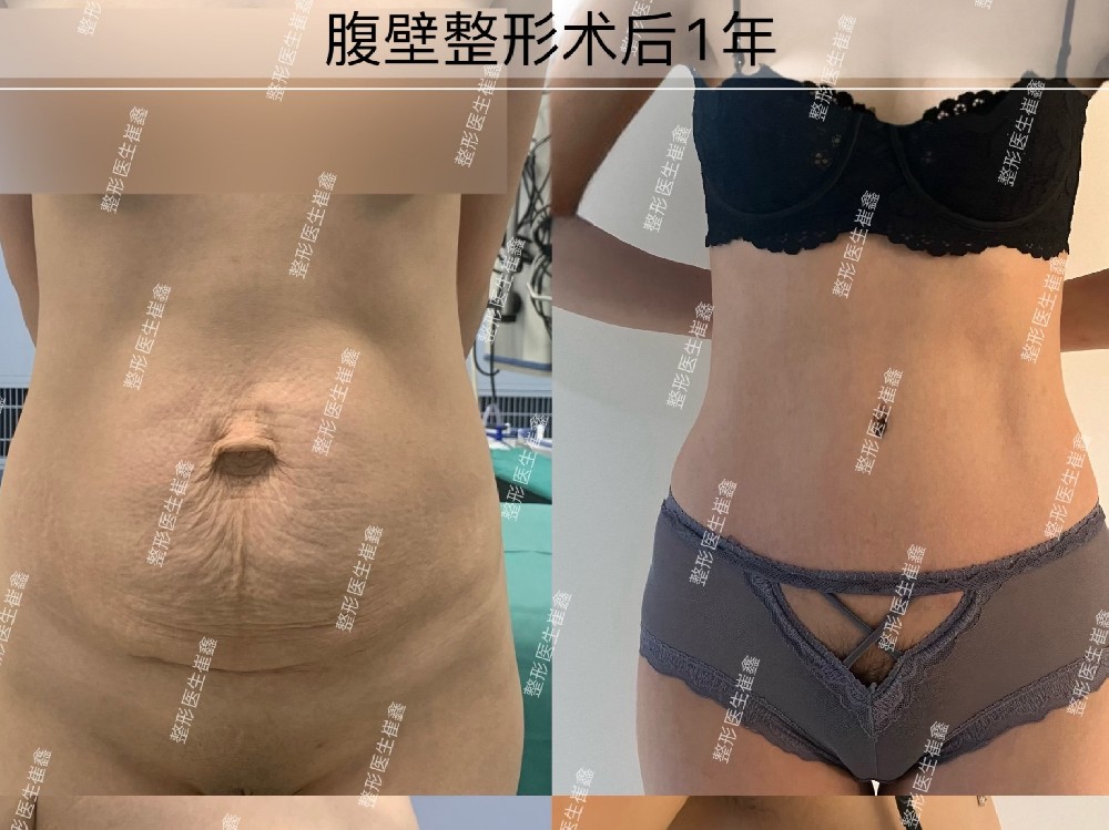 腹壁整形术后1年