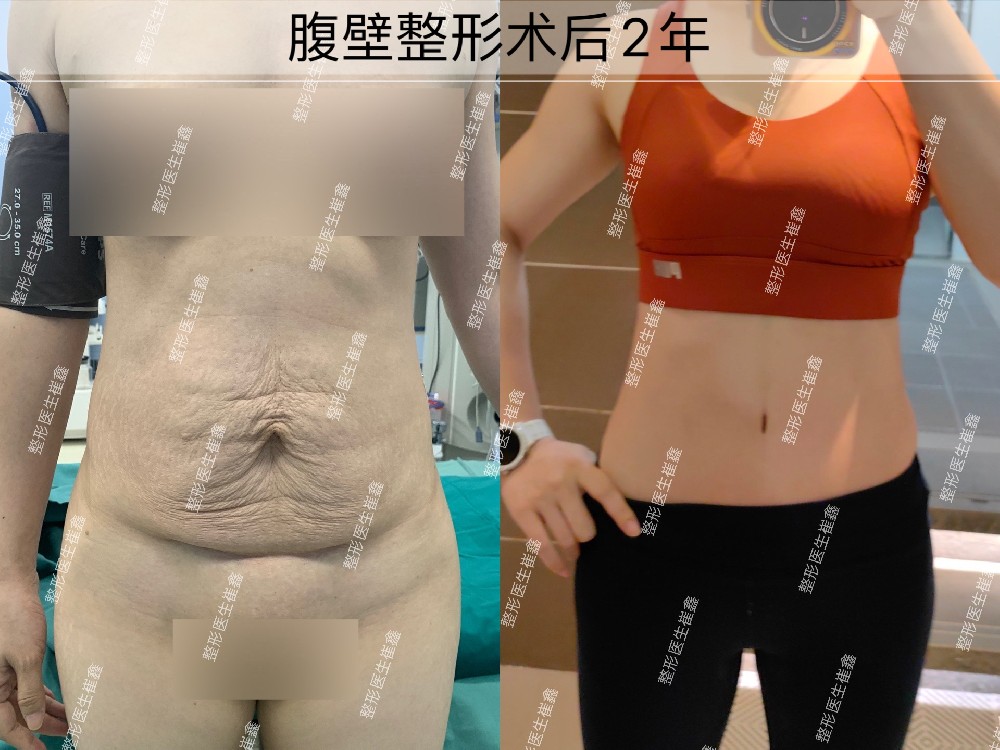 腹壁整形术后2年