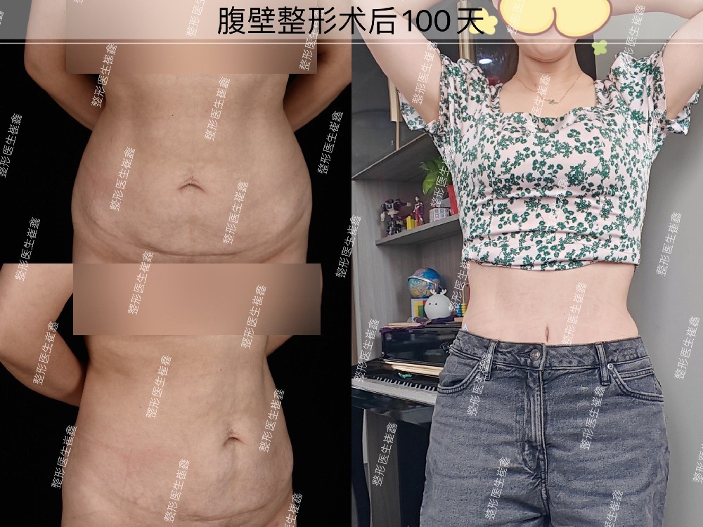 腹壁整形术后100天
