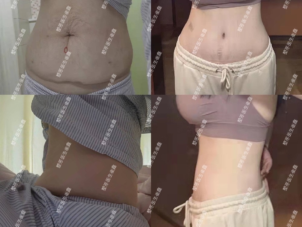 腹壁整形术后3个月