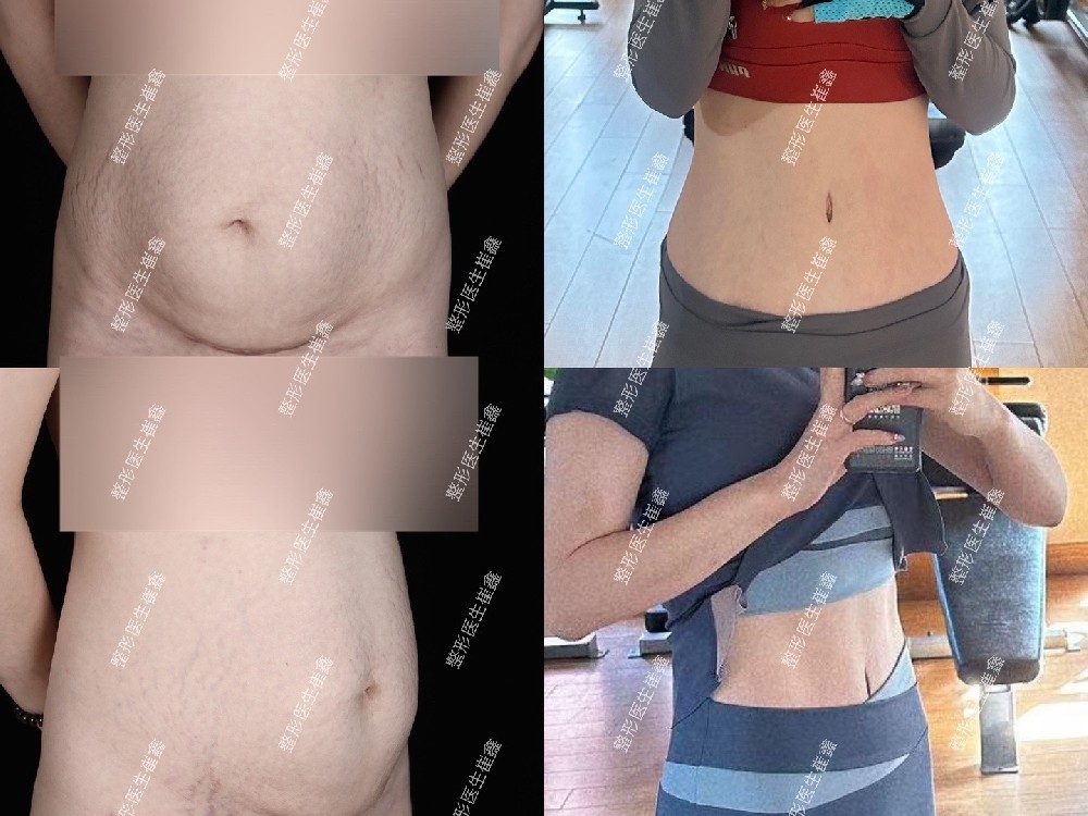 腹壁整形术后17个月