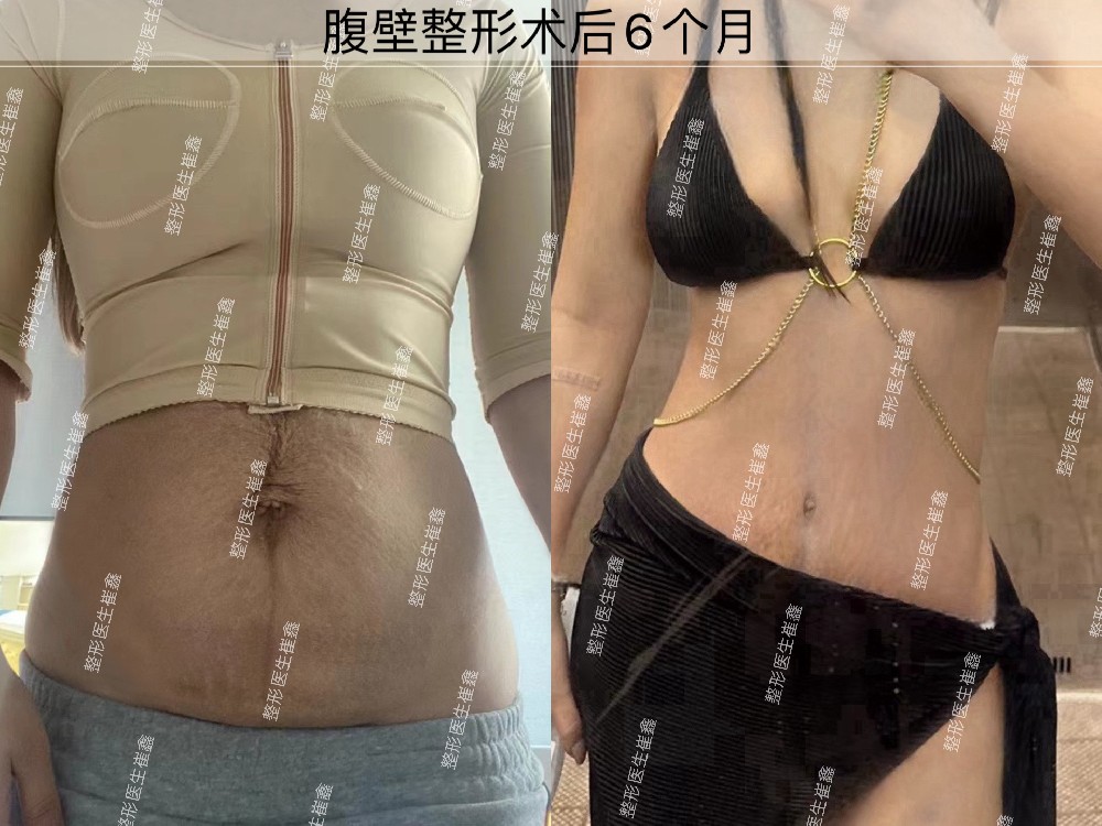 腹壁整形术后6个月