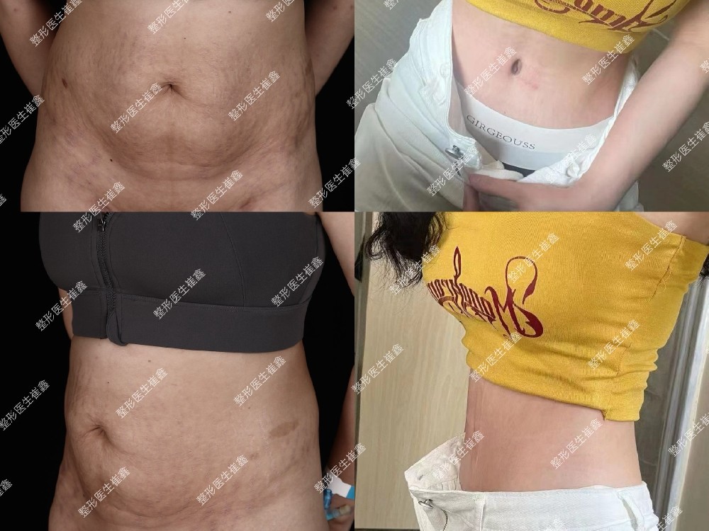 腹壁整形术后30天