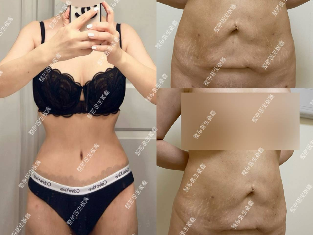 腹壁整形术后5个月