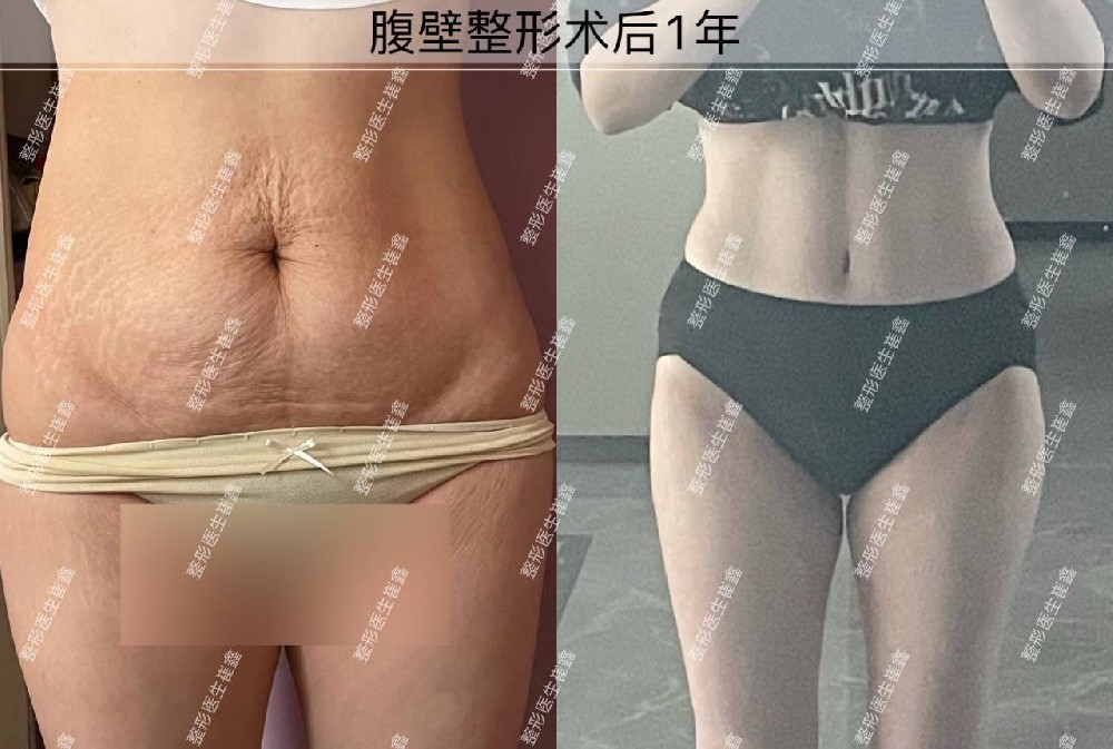腹壁整形术后1年