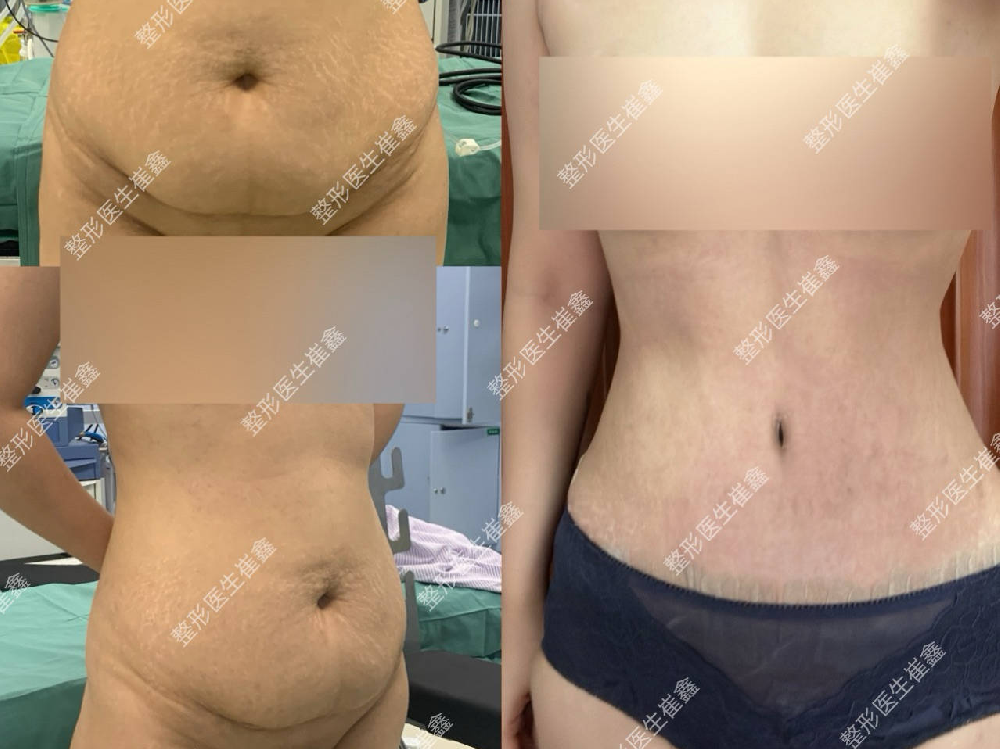 腹壁整形术后42天