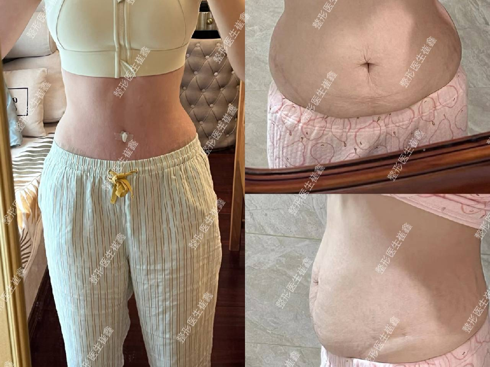 腹壁整形术后30天