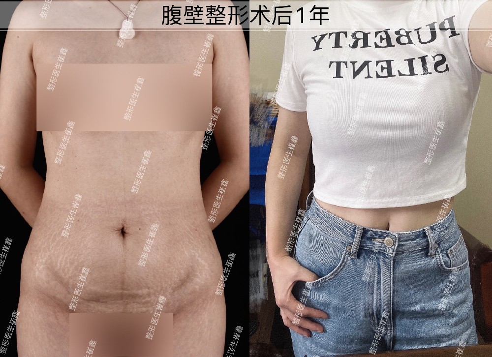 腹壁整形术后1年