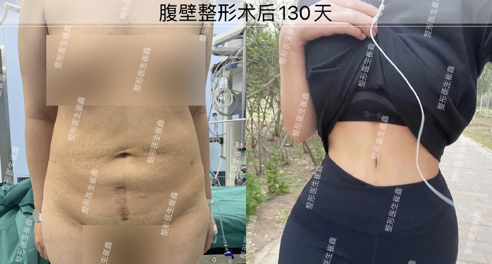 腹壁整形术后130天