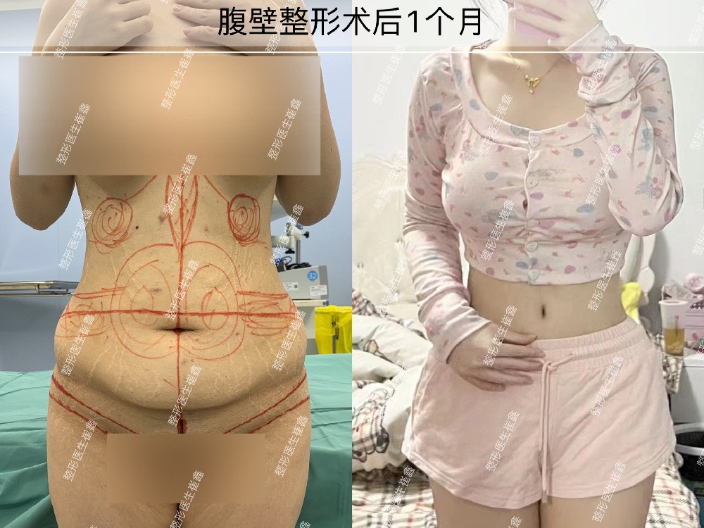 腹壁整形术后1个月