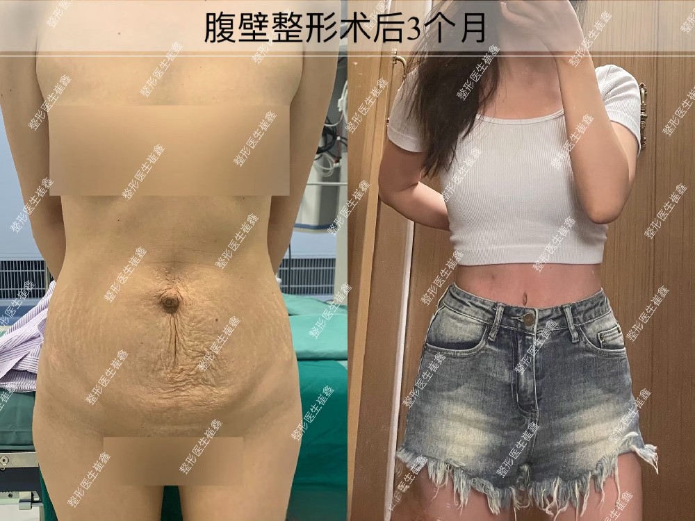 腹壁整形术后3个月