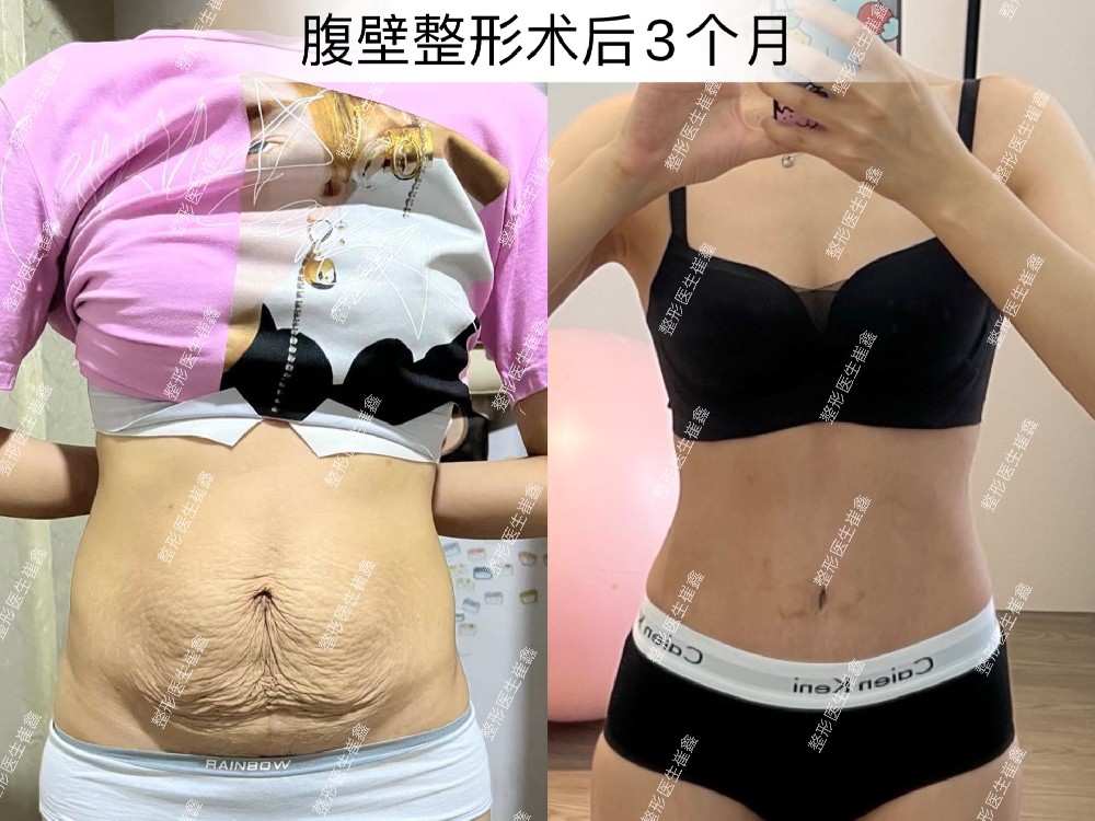 腹壁整形术后3个月