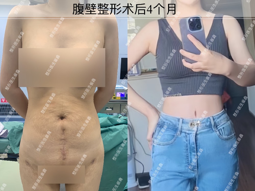 腹壁整形术后4个月