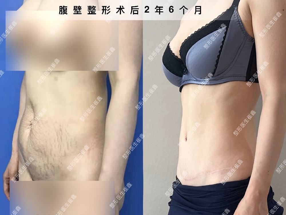 腹壁整形术后2年6个月