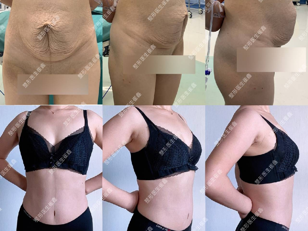 腹壁整形术后1年