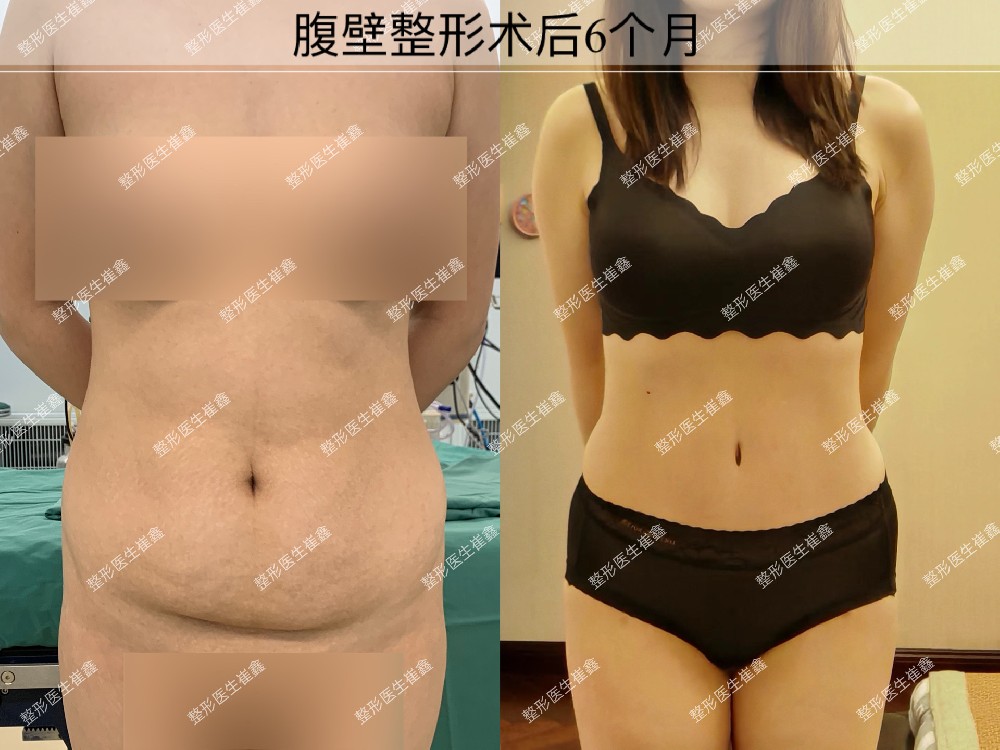 腹壁整形术后6个月