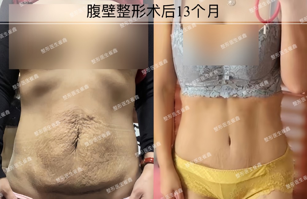 腹壁整形术后13个月