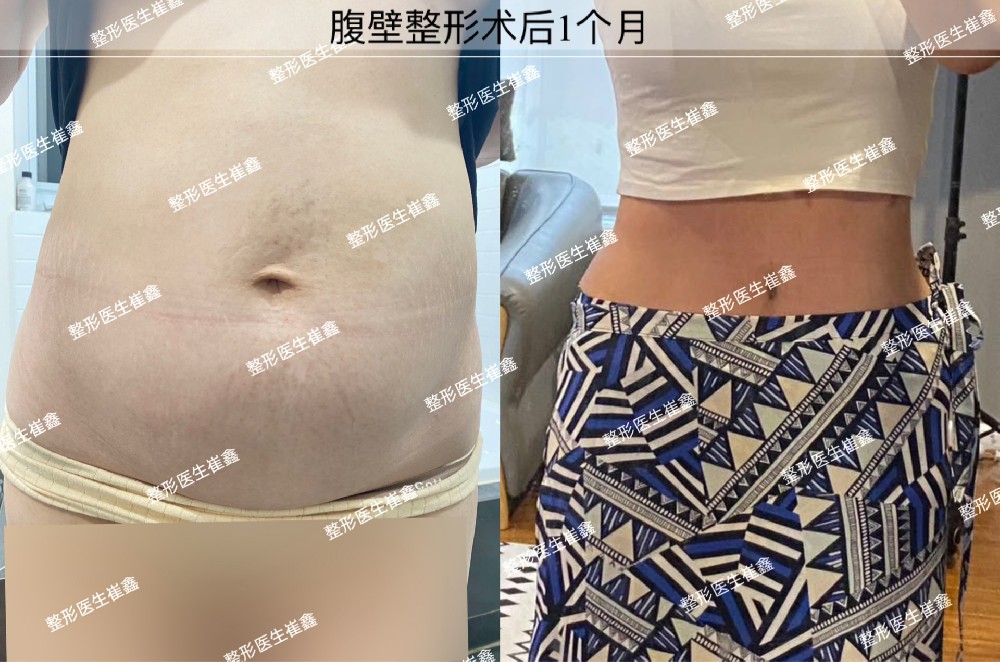 腹壁整形术后1个月