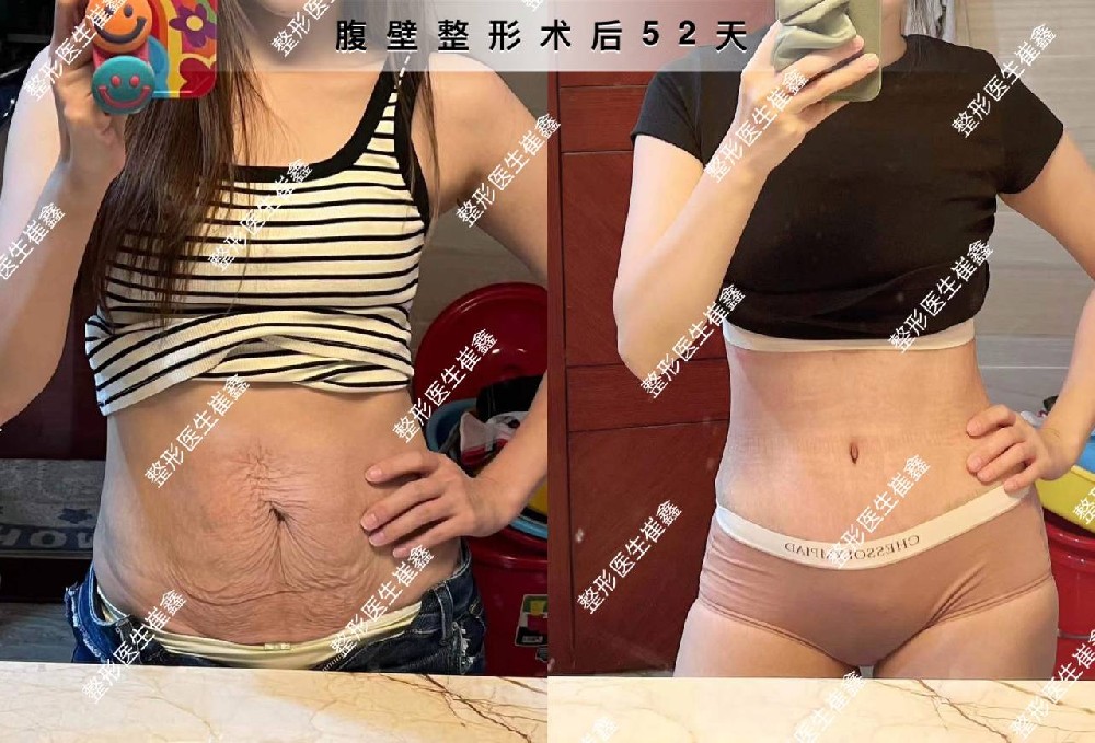 腹壁整形术后52天