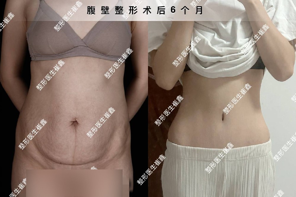 腹壁整形术后6个月