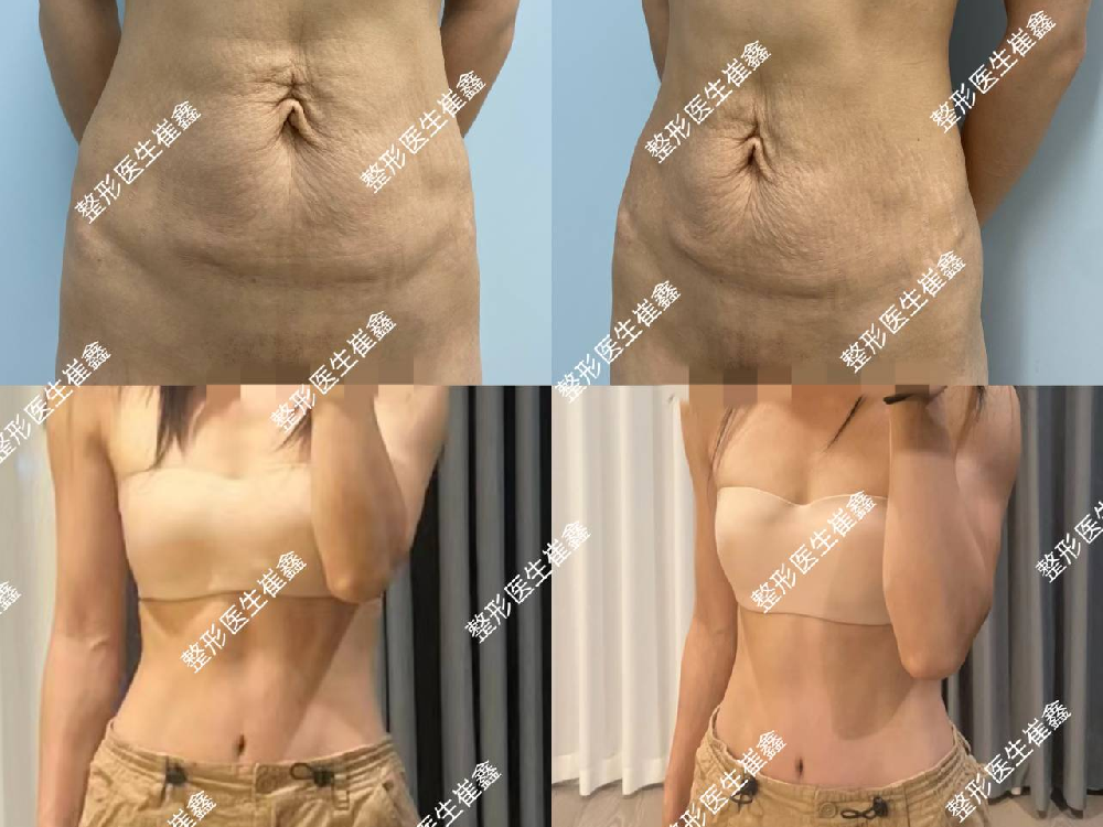 腹壁整形术后70天