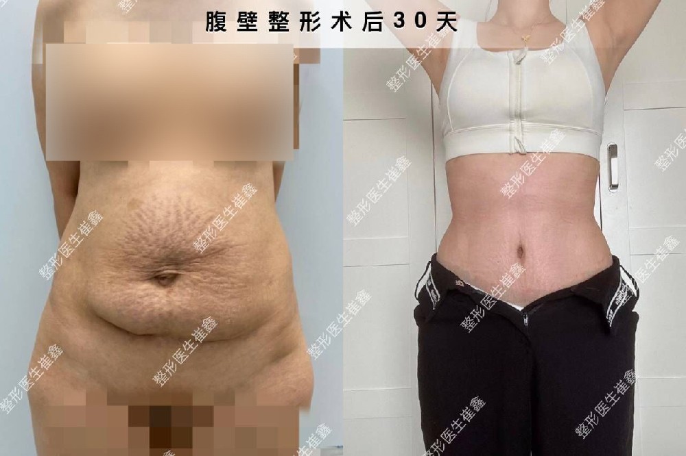 腹壁整形术后30天